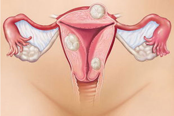 子宫肌瘤原因 为什么会长子宫肌瘤 女性健康