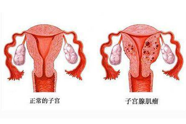 女性子宫肌瘤症状 子宫肌瘤引发原因 