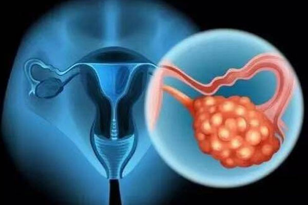 女性卵巢癌症状 卵巢癌发病率 女性卵巢癌