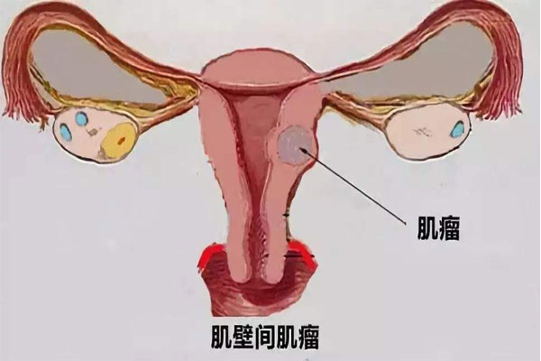 关于子宫肌瘤常见误区 子宫肌瘤错误认知 正确看待子宫肌瘤