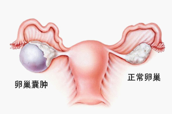 卵巢囊肿的高发人群有哪些 卵巢囊肿症状有哪些 卵巢囊肿的外在表现