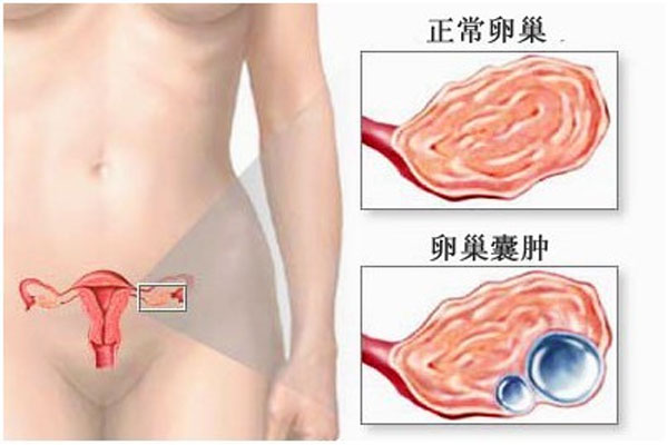 卵巢囊肿会引发哪些不适症状 预防卵巢囊肿的措施 卵巢囊肿的外在表现