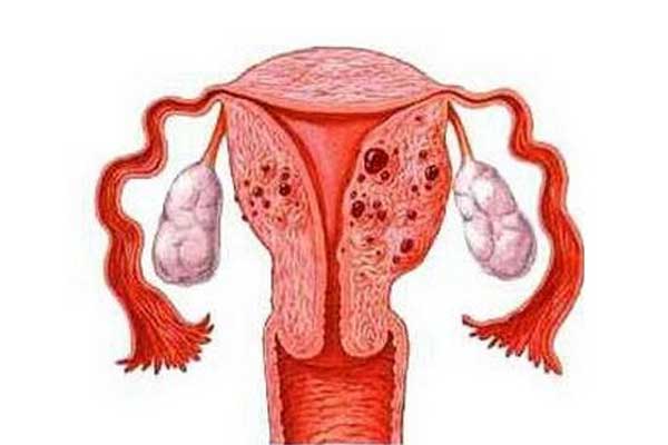 子宫腺肌症女性怎样备孕