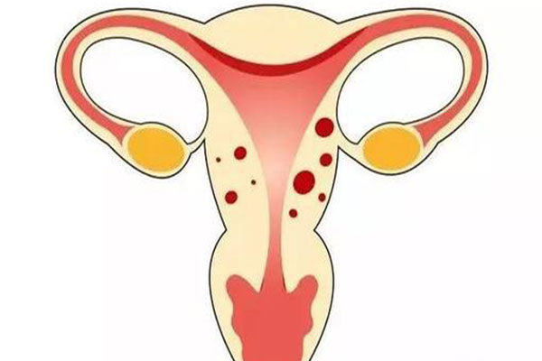 症的一種,是指子宮內膜異位到子宮肌層,其主要症狀是月經量增多和痛經
