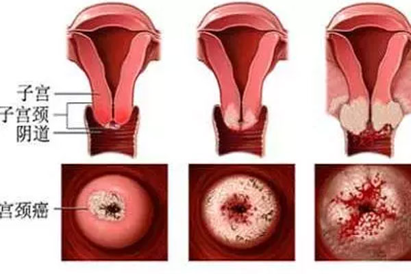 宫颈癌筛查