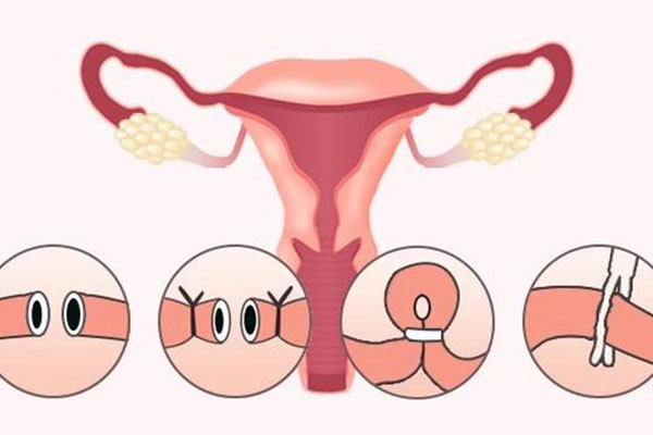 不孕的治疗 输卵管不通造成不孕