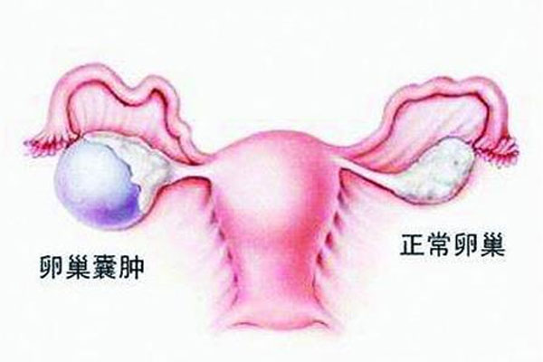 卵巢囊肿原因