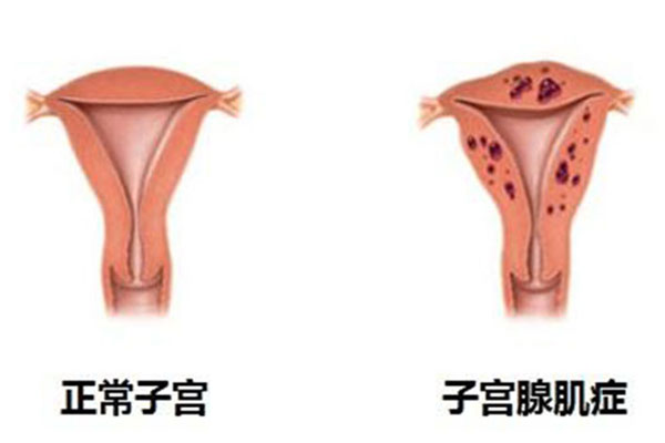 子宫腺肌症 女性健康