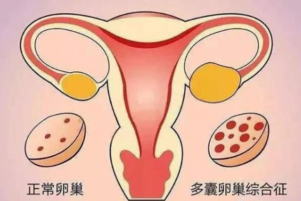 多囊卵巢综合征 多囊卵巢综合征如何治疗