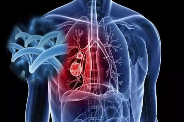 肺癌,肺癌咳嗽的特点,肺癌引起的咳嗽