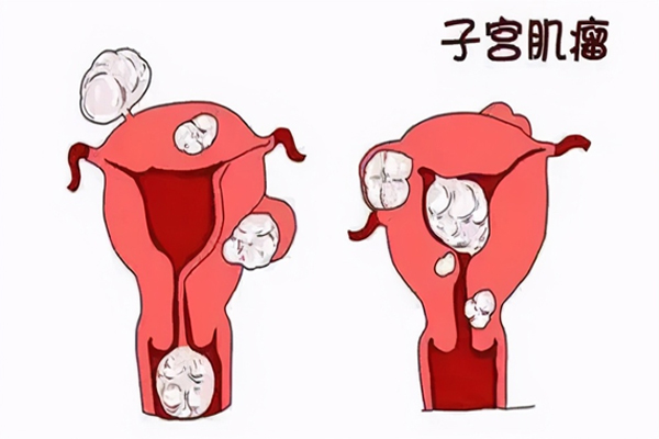 子宫肌瘤,子宫肌瘤的诱因