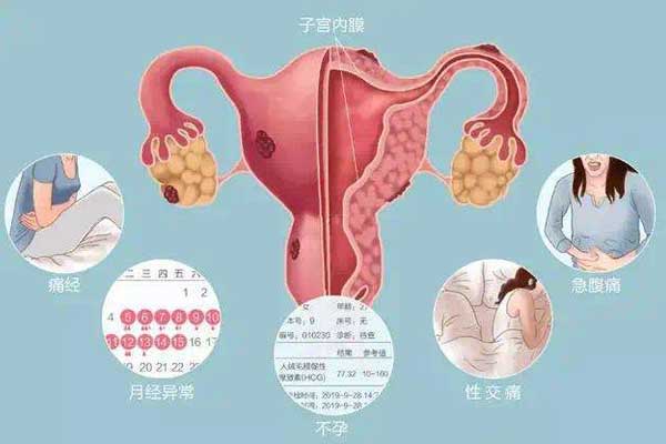 子宫内膜异位症可引发的疾病