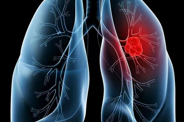 肺癌,肺癌误区,肺癌治疗的误区