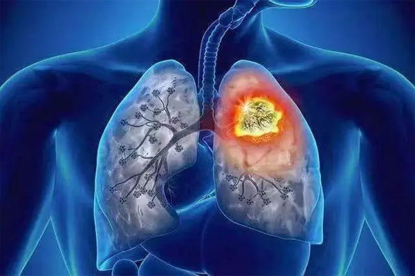 肺癌,肺癌的病因