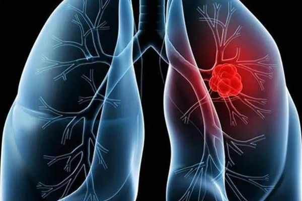 肺癌,肺癌的早期症状