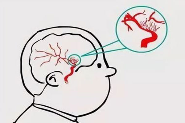脑出血患者该如何护理
