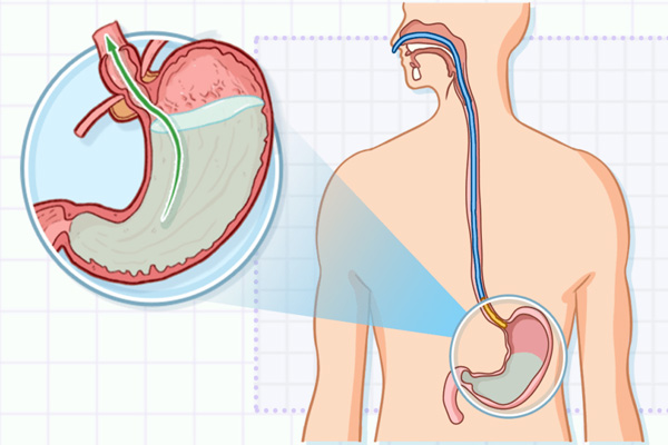 胃反酸?你真的知道什么是胃部反酸么?