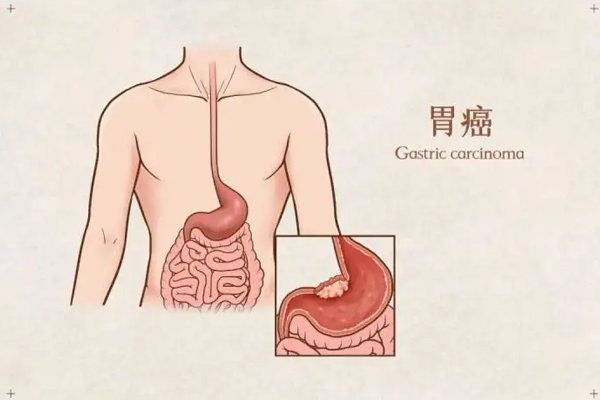 胃癌的早期症状表现