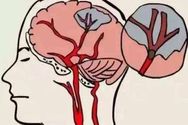 脑出血的原因,脑出血的病因