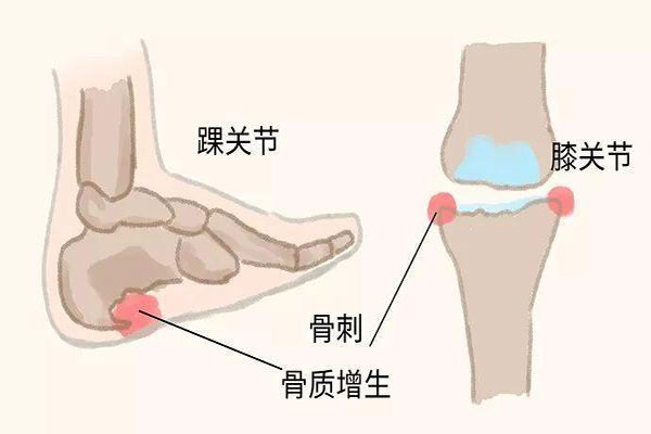 哪些人群易产生骨刺