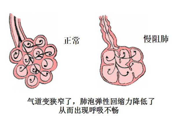 慢阻肺恢复治疗,慢阻肺治疗的恢复,振东健康