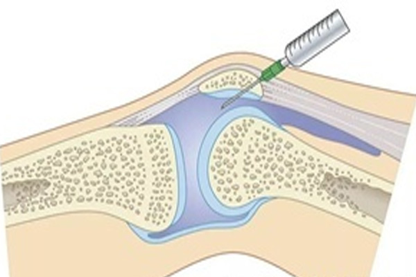 滑膜炎病发,滑膜炎病发的治疗,振东健康