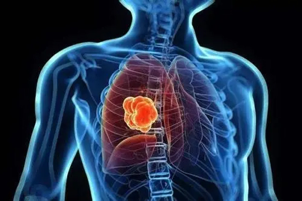 肺癌,肺癌的危险因素