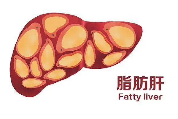 脂肪肝,脂肪肝的原因