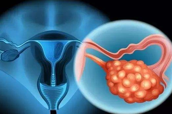 女性卵巢癌,女性卵巢癌病发,振东健康