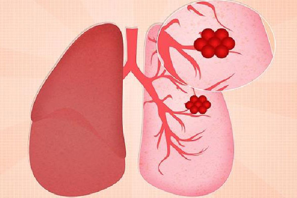 冬季如何预防阻塞性肺气肿
