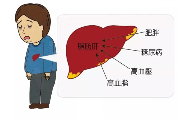脂肪肝的典型症状