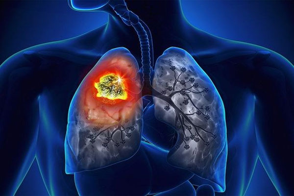 肺癌,肺癌的护理措施