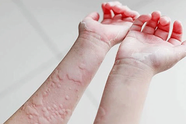 治疗荨麻疹的方法