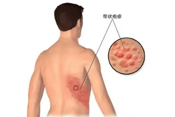 带状疱疹,带状疱疹后遗神经痛,振东健康