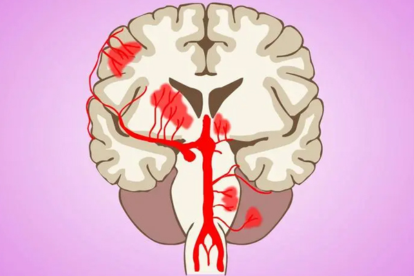 脑出血的治疗方法有哪些？这几种方式要了解