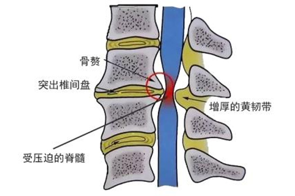 颈椎病发作,颈椎病发作类型,振东健康