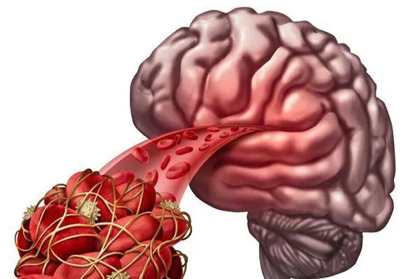 脑出血,脑出血与脑血栓的区别