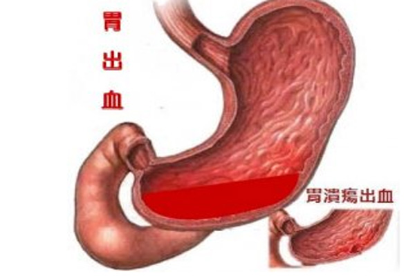 胃溃疡症状,胃溃疡的典型症状,振东健康