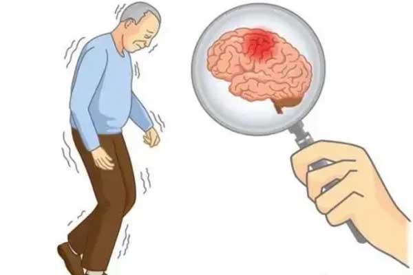 脑梗,脑梗是什么,脑梗的表现,脑梗的征兆有哪些,导致脑梗的因素有哪些