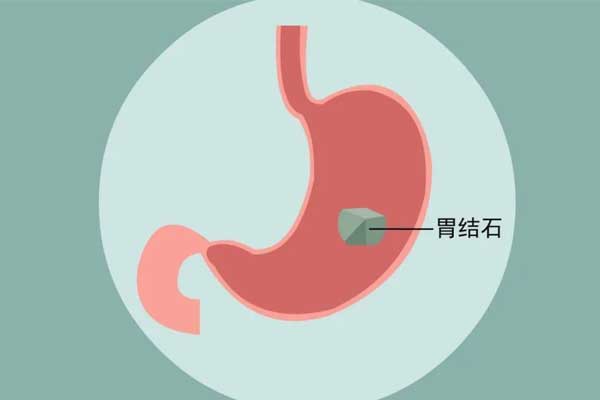 胃结石,胃结石有哪些症状,引发胃结石的原因有哪些,怎样预防胃结石,