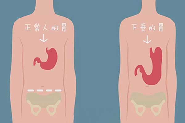 胃下垂,什么是胃下垂,胃下垂的症状,饭后剧烈运动的危害