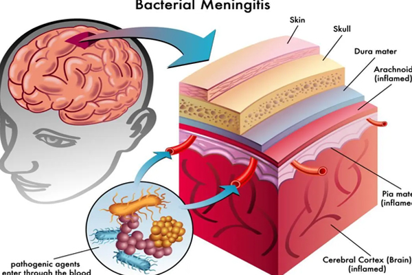 脑膜炎,脑膜炎的类型