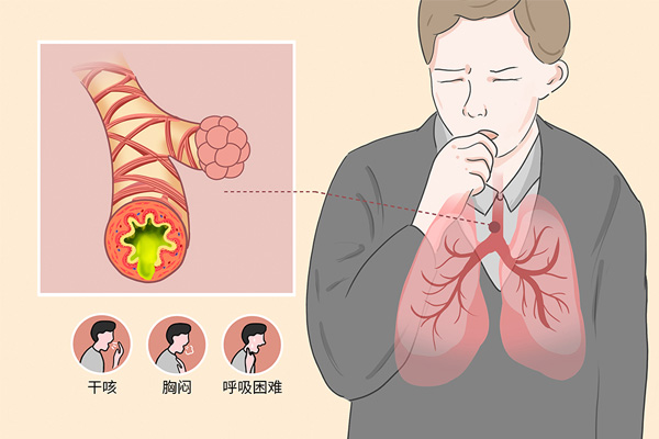 哮喘发作,哮喘发作类型,哮喘症状,振东健康