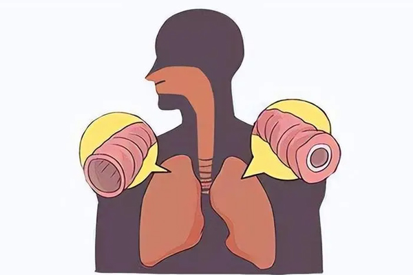 支气管扩张,支气管扩张的症状