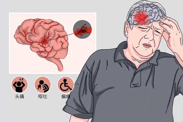 神经疾病,脑卒中,脑出血,什么是脑出血,脑出血的早期表现,如何预防脑出血,振东健康网