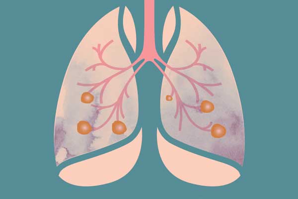 肺结节,什么是肺结节,肺结节的病因,导致肺结节的原因