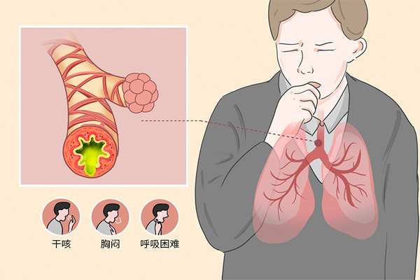 过敏性肺炎,咳嗽变异性哮喘,振东健康