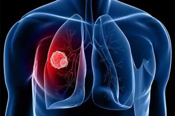 肺癌,什么是肺癌,肺癌的病因,肺癌的治疗方法,