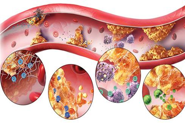 动脉粥样硬化,预防动脉粥样硬化,动脉粥样硬化的病因,振东健康