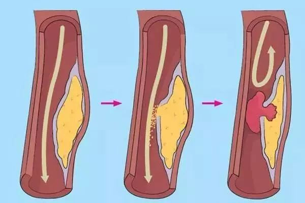 动脉粥样硬化,动脉粥样硬化症状,振东健康
